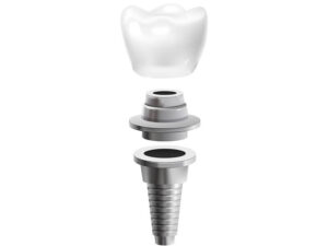 implante dentário