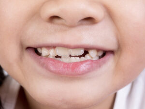 dentes apinhados